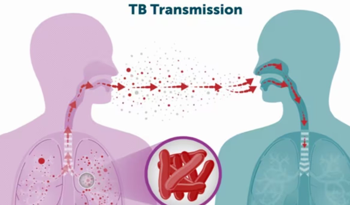 कर्णाली प्रदेशमा आठ सय ६१ क्षयरोगी फेला