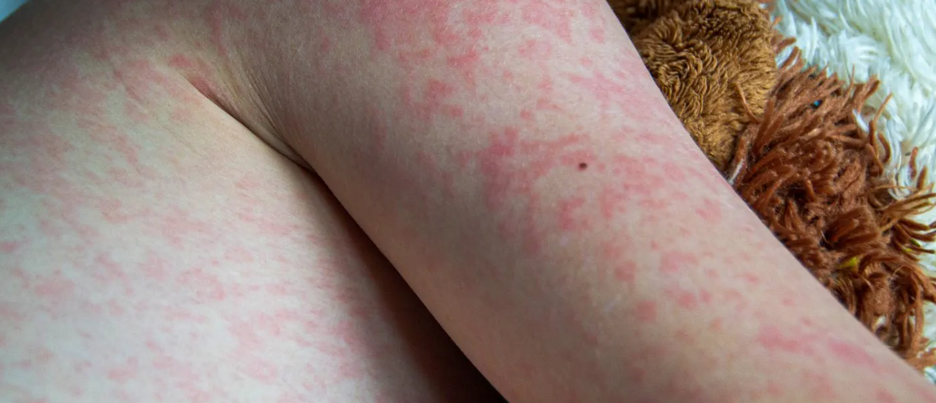 ढोरपाटनमा दादुरा फैलिएपछि विद्यालय बन्द